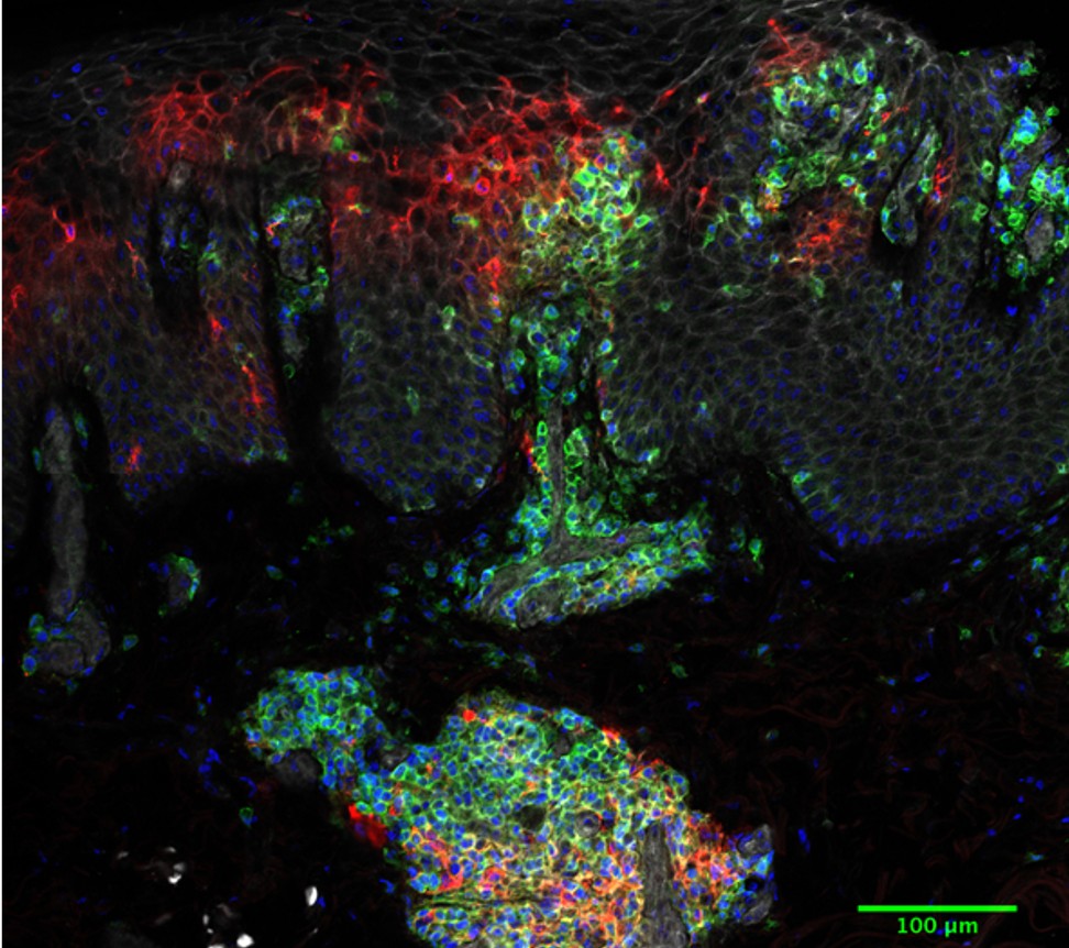 Collagen IV(red)  and T cells (green) in active psoriasis