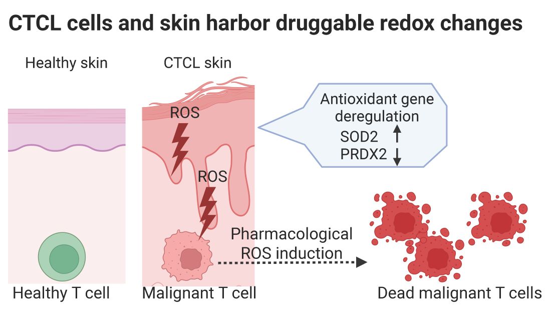 Malignant T cells and tissue from Cutaneous T cell Lymphoma have a distinct redox gene signature and increased levels of Reactive Oxygen Species (ROS), leaving the malignant cells vulnerable to further increases in ROS 