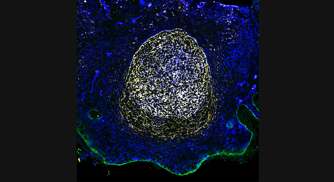 depicts fluorescent immunohistochemistry staining of a human lung TB granuloma: macrophages are marked by CD68 in yellow, SPP1+ cells are marked in green, macrophages enriched in alveolar spaces are marked by CD206 in red, and nuclei are depicted in blue (DAPI staining). Image © Mbano et al., 2026.